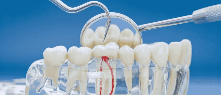 cracked tooth vs root canal